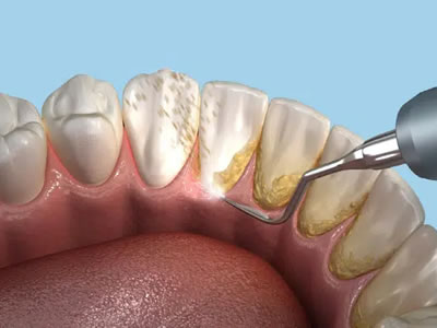 Dental Cleaning