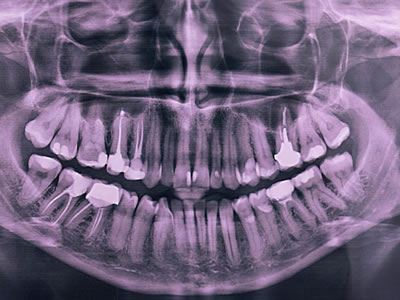 Dental Xrays