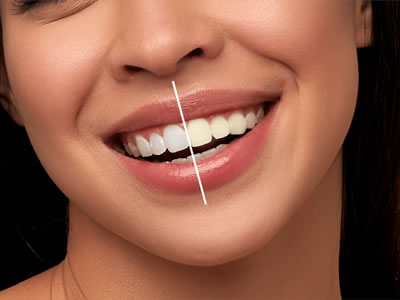 Teeth Whitening
