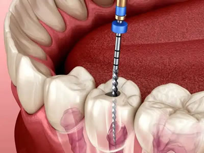 root canal