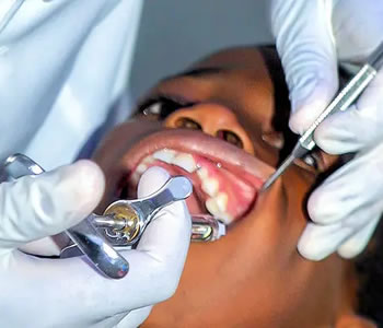 complex dental extractions