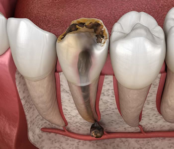 tooth cysts