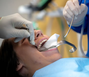 wisdom teeth removal